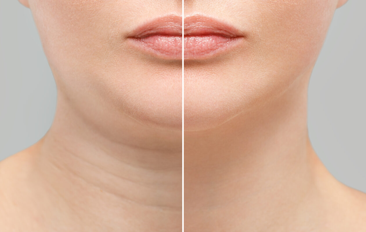 Female double chin before and after correction. Correction of the chin shape liposuction of the neck. The result of the procedure in the clinic of aesthetic medicine.