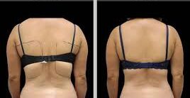 Bra Bulge Liposuction Before & After
