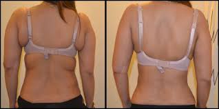Bra Bulge Liposuction Before And After