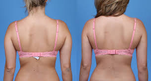 Bra Bulge Liposuction In Turkey