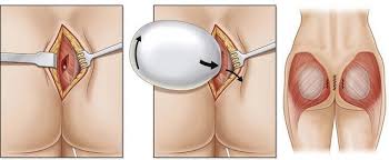 Brazil Butt Lift (BBL) with Laser Liposucrion