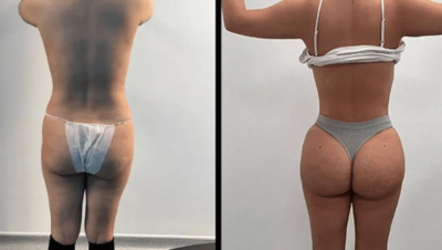 Brazilian butt lift with HD Lipo
