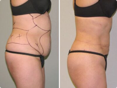 Laser liposuction in Turkey
