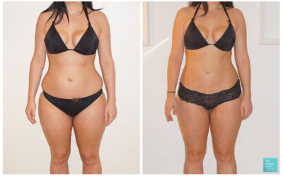Laser liposuction in Turkey
