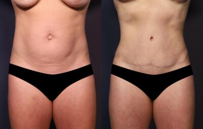 Mommy Makeover Before and After