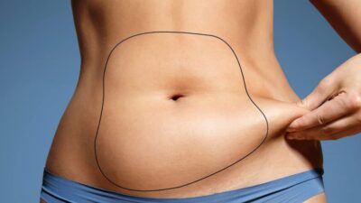 Mommy makeover with HD Lipo