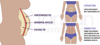 Mommy makeover with Laser Liposuction