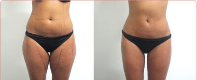 Thigh Liposuction Before & After