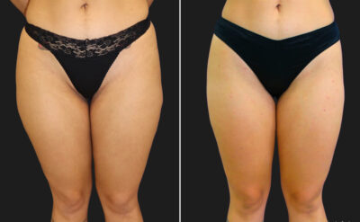 Thigh Liposuction Before And After