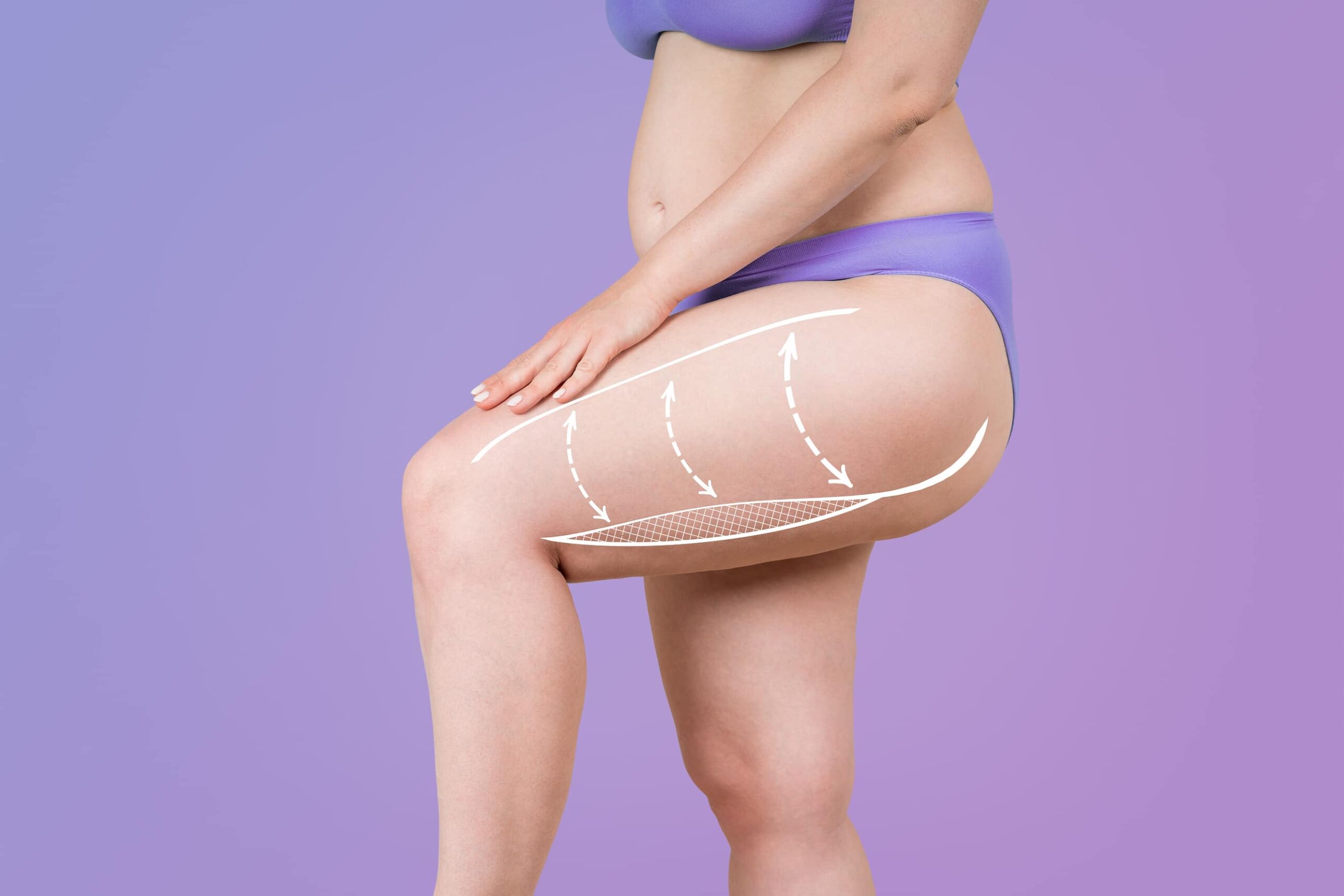 Thigh Liposuction in Turkey