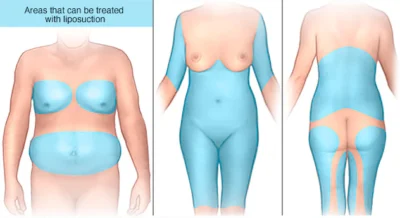 Types of abdominal liposuction