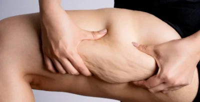 Why Choose Thigh Liposuction in Turkey