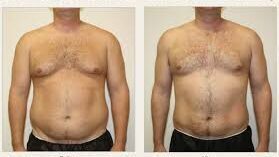 abdominal liposuction before & after