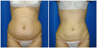 abdominal liposuction before and after
