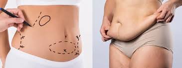 abdominal liposuction procedure